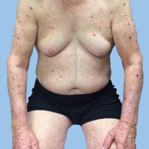 Image for DWII on Advances in pruritus therapeutics