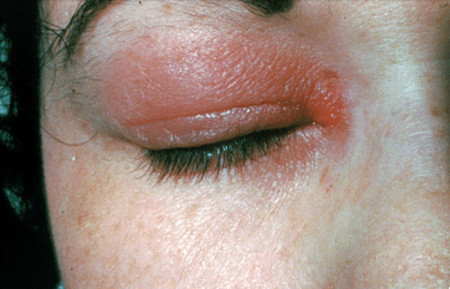 Allergic reaction on eyelid