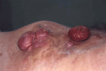 Dermatofibrosarcoma protuberans skin cancer on the surface of the skin