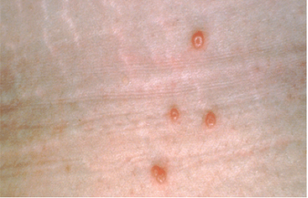 Molluscum contagiosum dome shaped bumps