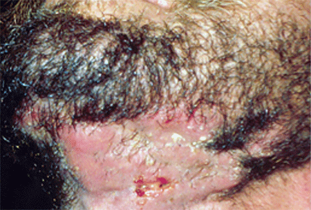 Ringworm infection on the bearded area of the neck