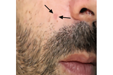 Basal cell carcinoma that looks like an age spot 