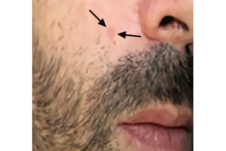 Skin Cancer Types Basal Cell Carcinoma Signs And Symptoms Skin Cancer Types Basal Cell Carcinoma Signs And Symptoms