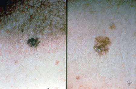 Close-up images of melanoma that look like an odd-shaped mole