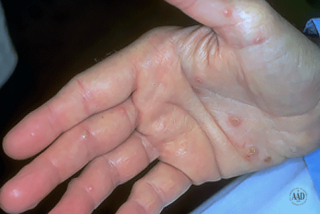 Shingles rash on the palm of a man's hand