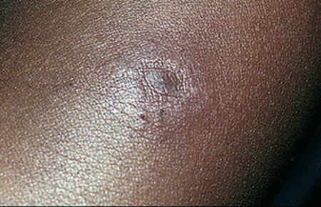 Early rash caused by Lyme disease