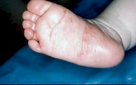 Scabies rash on foot of infant child