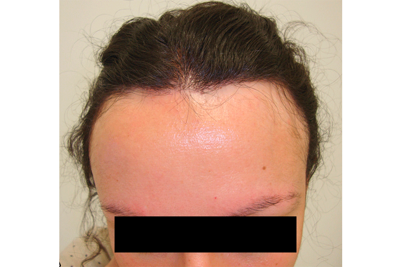 Frontal Fibrosing Alopecia How Women Are Conquering Their Hairline Blues   A Divas Hidden Hair Manufacturer