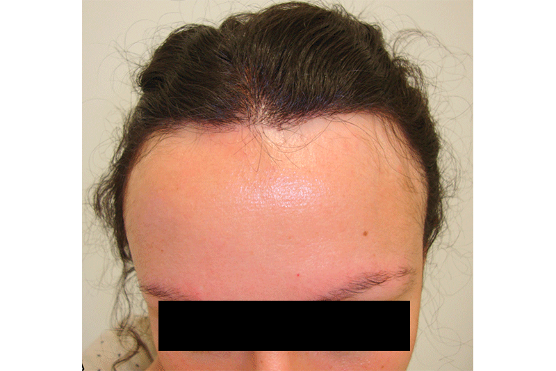 Alopecia Archives  Skin of Color Update  Dermatology Conference  New  York City