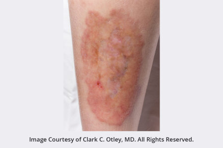 diabetes skin rash images