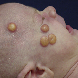 Card image for DWII of xanthogranulomas