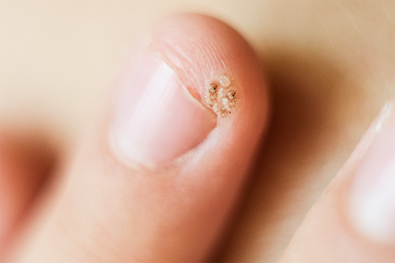 wart