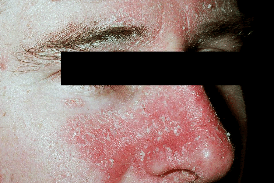 What Causes Seborrheic Dermatitis Face