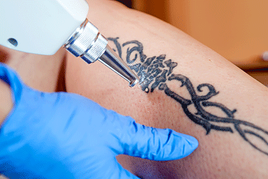 Laser tattoo removal from leg