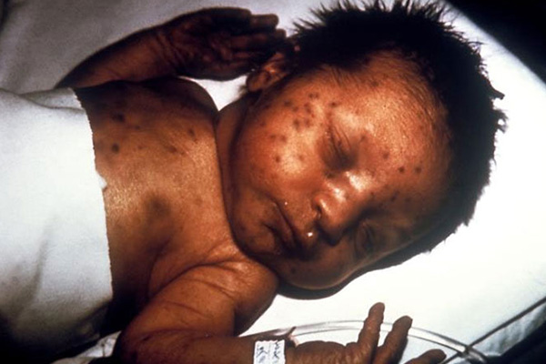 Figure 1. This infant presented with classic “blueberry muffin” papulonodules seen in congenital rubella. These lesions are cutaneous sites of extramedullary hematopoiesis and can occur in several congenital viral infections and hematologic diseases.