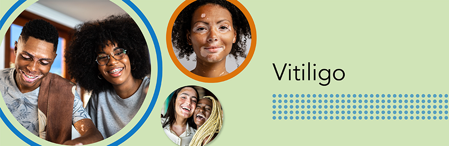 Good Skin Knowledge: Lesson plans: Module 11: Vitiligo - hero image