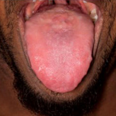 Image for DWII of lipoid proteinosis