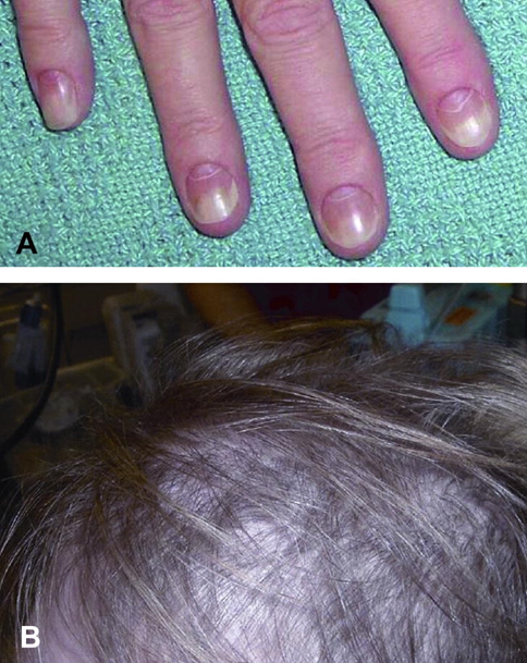 Image for DWII of Cronkhite-Canada syndrome