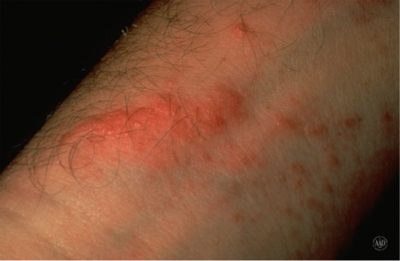 Don't be rash: tidbits about Lyme disease, poison ivy, and sunburn