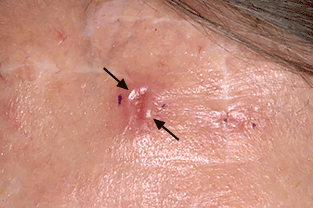 Shiny, pinkish basal cell carcinoma that looks like a skin injury