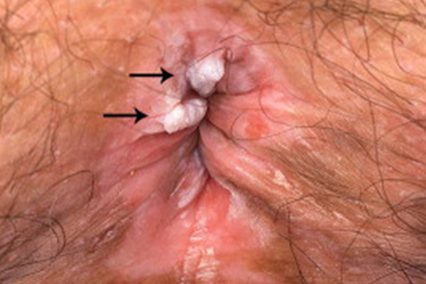 Figure 5. Verrucous anal intraepithelial neoplasia. Source: JAAD. (8)