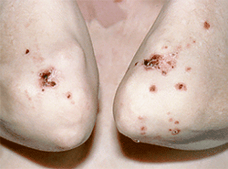 Drug-induced pemphigus blisters