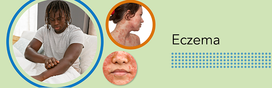 Good Skin Knowledge: Lesson plans: Module 9: Eczema - hero image