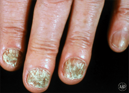 Ringworm infection on several nails