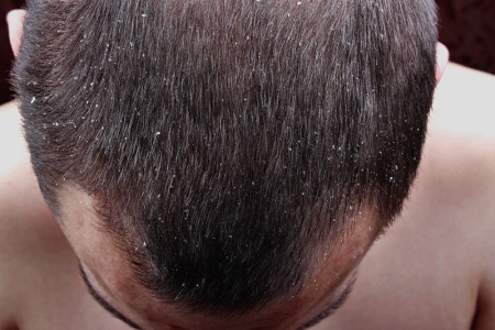 Symptoms of dandruff on the scalp of a man.
