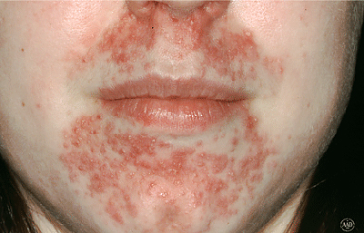 Woman with perioral dermatitis.
