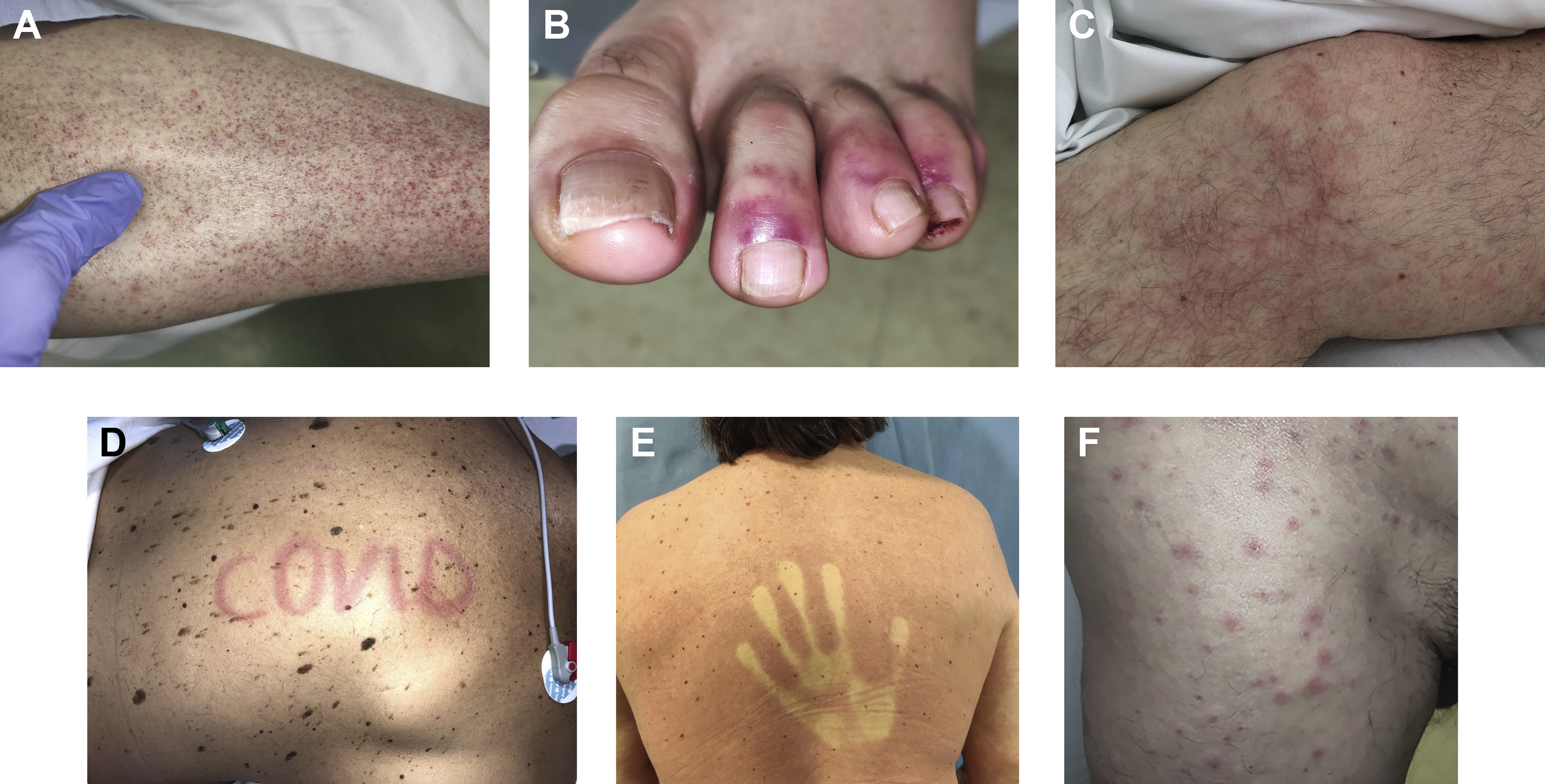 Figure 1. Examples of coronavirus disease 2019-associated rash with petechiae (A), acral ischemia (B), livedo reticularis subtype located on the lower extremities (C), urticaria (D), erythema (E), and vesicles (F). the erythematous rash blanches on pressure, whereas rashes with petechiae, livedo reticularis subtype, and acral ischemia do not. The urticarial rash may be associated with dermographism. SARS-CoV-2 infection was confirmed in all the patients by reverse-transcriptase polymerase chain reaction assay. Source: JAAD. (5)