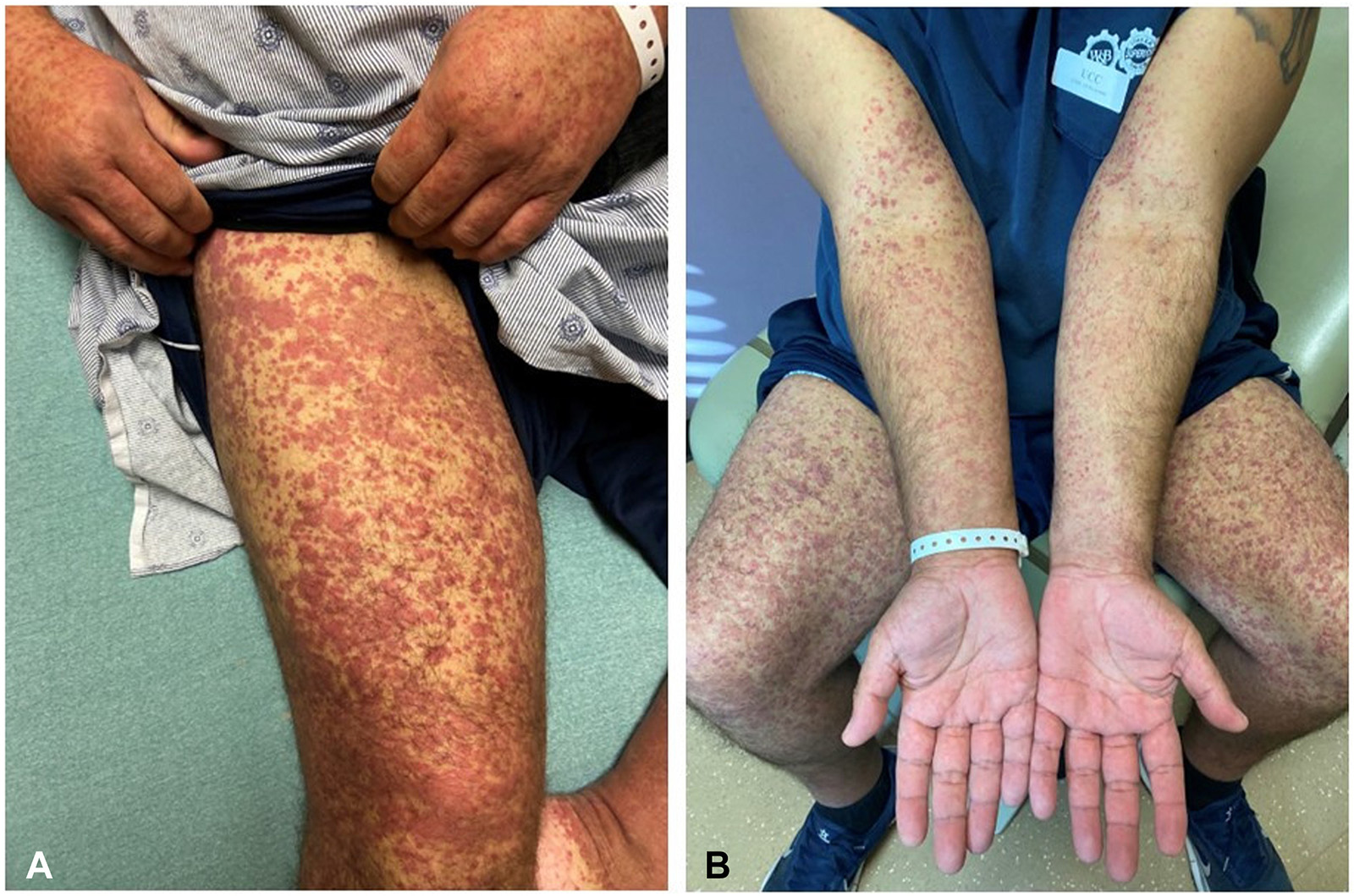 Image for DWII of vasculitis