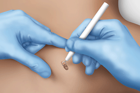 Using a curette to remove skin for a skin biopsy
