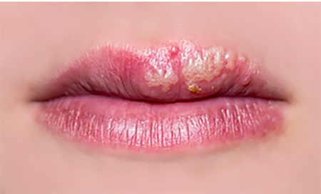 Cold Sores Should I Keep A Child With Eczema Away