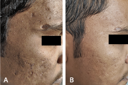 Before and after microneedling performed by a dermatologist