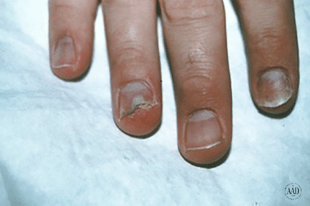 Squamous cell skin cancer has eaten part of the fingernail