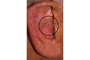 Squamous cell carcinoma often looks like dry, rough skin, such as the patch in this patient’s ear, circled | American Academy of Dermatology (AAD). 