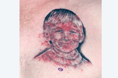 Image of infection caused by a tattoo