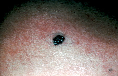 Close-up of an early melanoma mistaken for a mole