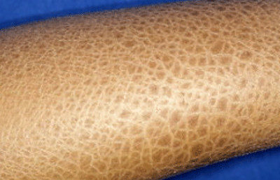 Ichthyosis vulgaris on arm