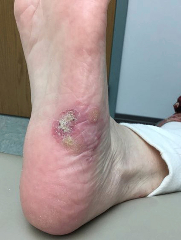 Photo for DWII of hypokeratosis on the foot