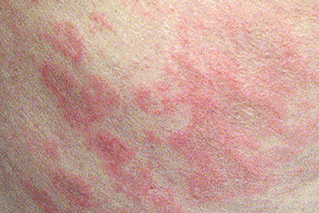 A rash caused by radiation therapy used to treat cancer