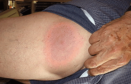 Lyme disease rash on leg