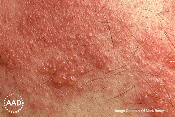 Varicella-zoster figure 1. “Dewdrop” vesicles on a “rose petal” erythematous base. Source: AAD.