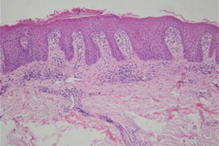 Eosinophils in psoriasis: The image is from JAAD Case Reports. 2015; 1(4): 230-3. 