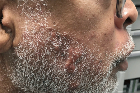 Keloid scars from chickenpox