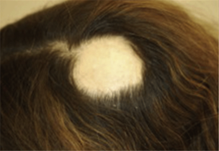thinning hair top of head