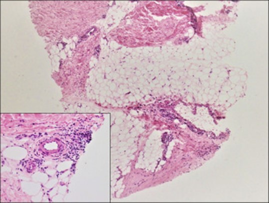 Image of biopsy of eosinophilic fasciitis