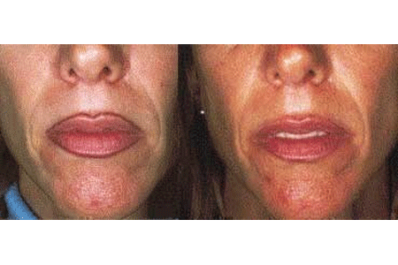 Before and after pictures of laser tattoo removal around the lips