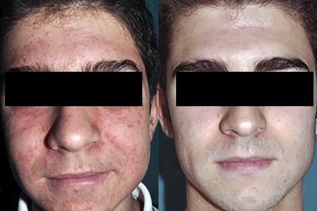 Before and after treatment for childhood rosacea